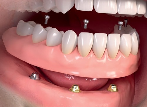  Implant cho người mất răng toàn hàm