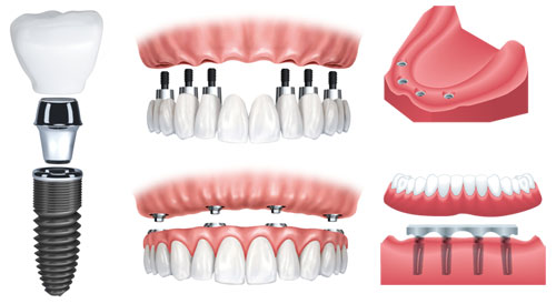  Quy trình Implant khôi phục răng người mất răng toàn hàm