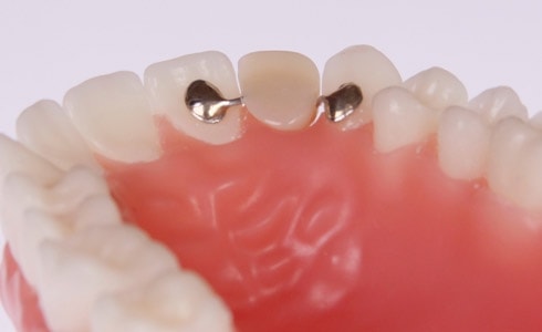  Các loại cầu răng
