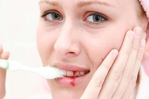  5 nguyên nhân chảy máu nướu răng bạn cần lưu ý