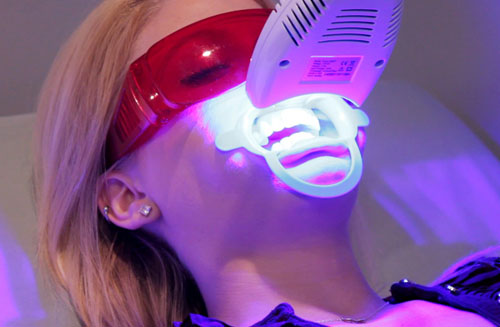  Tẩy trắng răng bằng công nghệ Laser