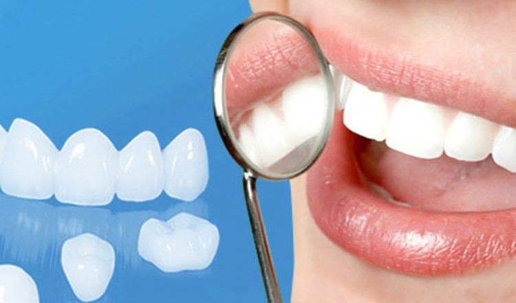  Veneer sứ – khôi phục răng nhiễm màu, răng ố vàng