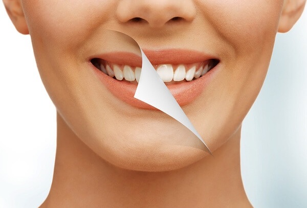  Tẩy trắng răng có an toàn?