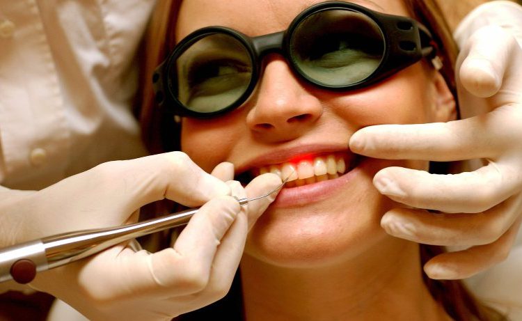  Laser điều trị bệnh nướu răng (viêm nha chu)