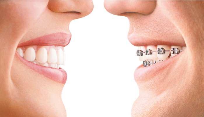 Răng cắn chéo – ảnh hưởng và phương pháp điều trị
