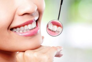Inlays và Onlays nha khoa thế giới đẹp