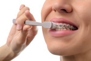 Chăm sóc răng miệng sau niềng răng