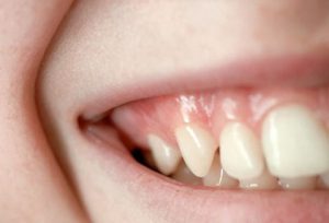 ghép nướu răng - nha khoa thế giới đẹp