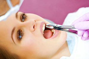 Nhổ răng tại Nha Khoa Thế Giới Đẹp